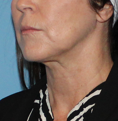Facelift Before and After | SGK Plastic Surgery