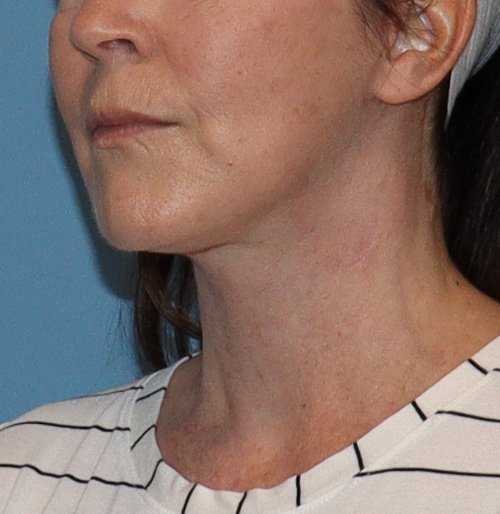 Facelift Before and After | SGK Plastic Surgery