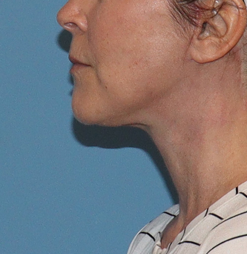 Facelift Before and After | SGK Plastic Surgery