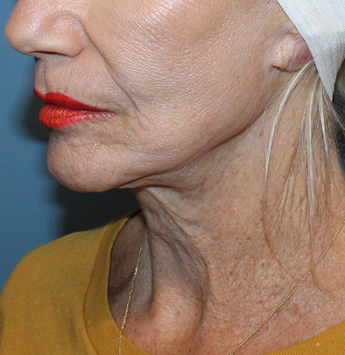Facelift Before and After | SGK Plastic Surgery