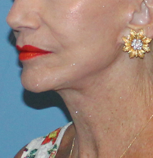 Facelift Before and After | SGK Plastic Surgery
