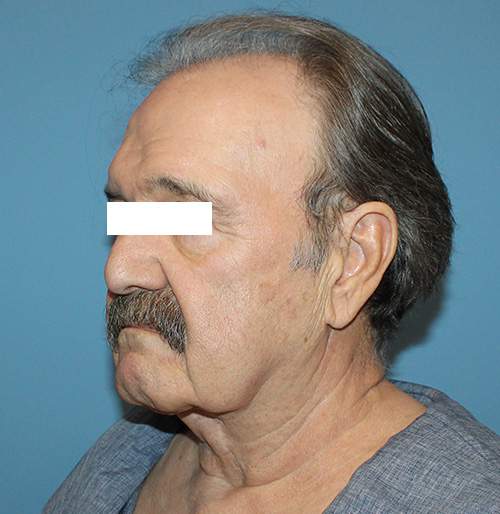 Facelift Before and After | SGK Plastic Surgery