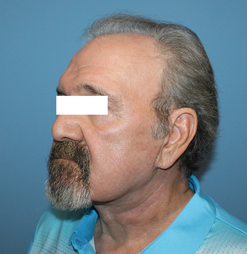 Facelift Before and After | SGK Plastic Surgery