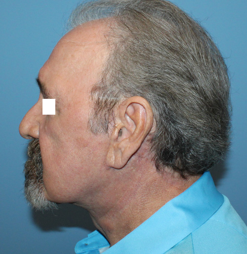 Facelift Before and After | SGK Plastic Surgery