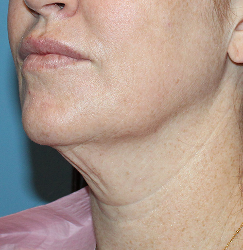 Facelift Before and After | SGK Plastic Surgery