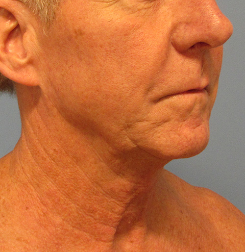 Facelift Before and After | SGK Plastic Surgery