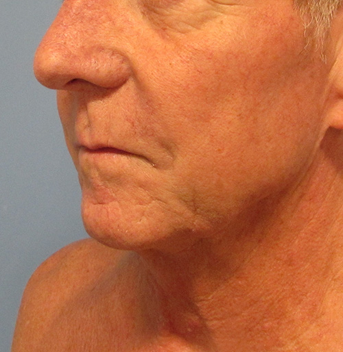 Facelift Before and After | SGK Plastic Surgery