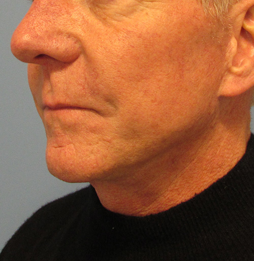 Facelift Before and After | SGK Plastic Surgery