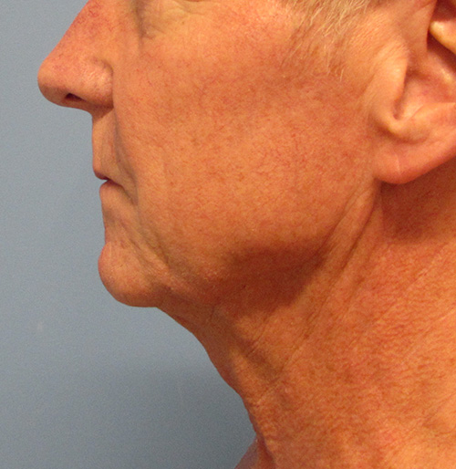 Facelift Before and After | SGK Plastic Surgery