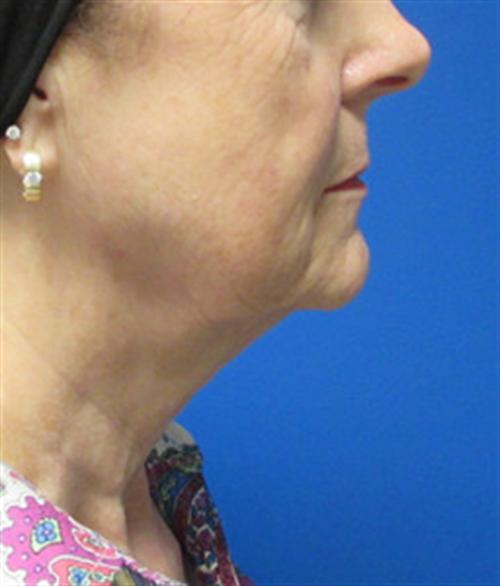 Facelift Before and After | SGK Plastic Surgery