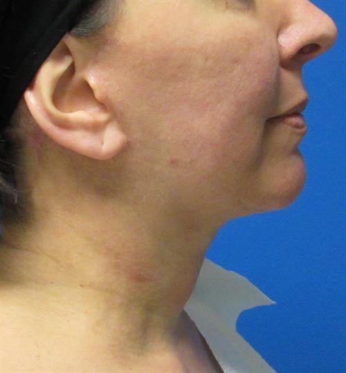 Facelift Before and After | SGK Plastic Surgery