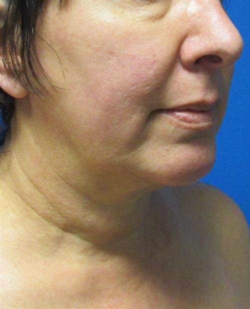 Facelift Before and After | SGK Plastic Surgery
