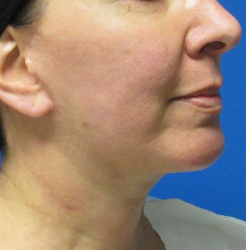 Facelift Before and After | SGK Plastic Surgery
