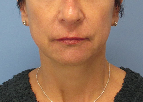 Facelift Before and After | SGK Plastic Surgery