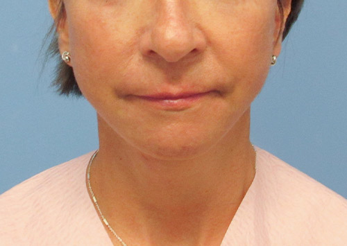 Facelift Before and After | SGK Plastic Surgery