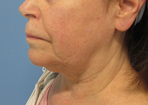 Facelift Before and After | SGK Plastic Surgery