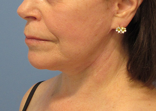 Facelift Before and After | SGK Plastic Surgery
