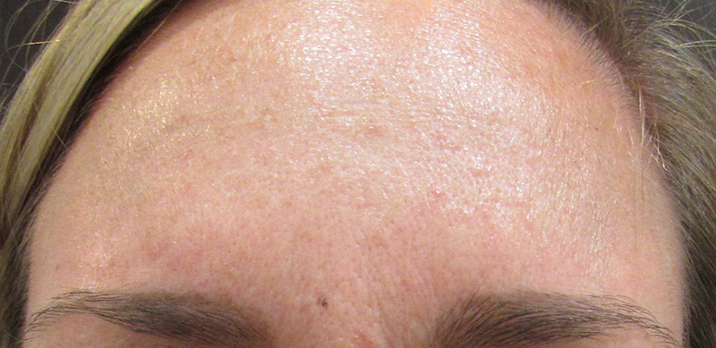 Botox Before and After | SGK Plastic Surgery