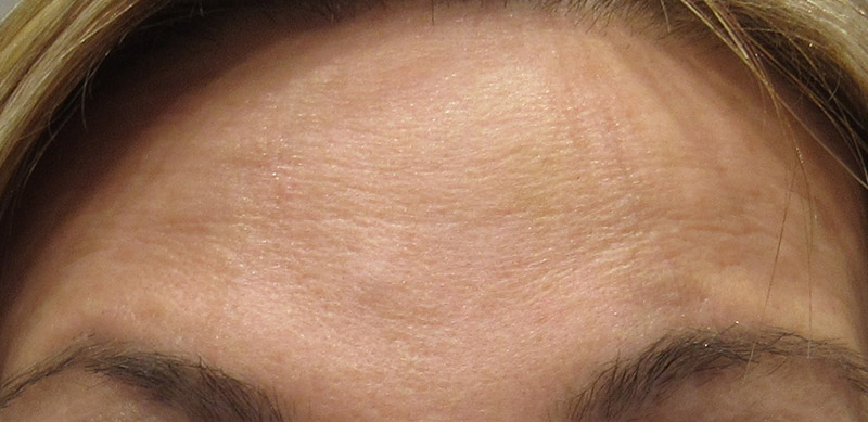 Botox Before and After | SGK Plastic Surgery