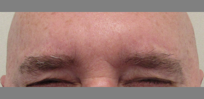 Botox Before and After | SGK Plastic Surgery