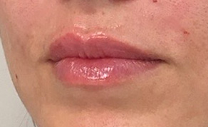 Injectables Before and After | SGK Plastic Surgery