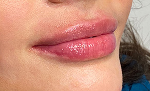 Injectables Before and After | SGK Plastic Surgery