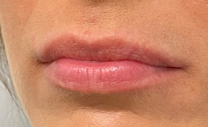 Injectables Before and After | SGK Plastic Surgery