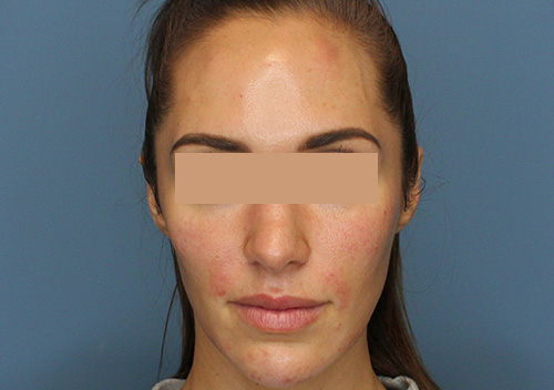 Injectables Before and After | SGK Plastic Surgery