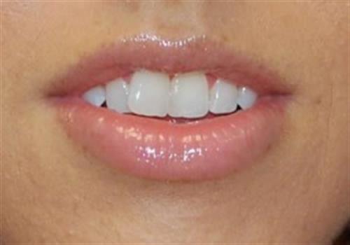 Injectables Before and After | SGK Plastic Surgery