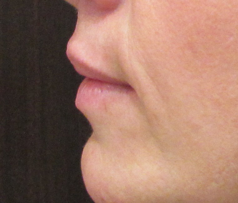 Injectables Before and After | SGK Plastic Surgery