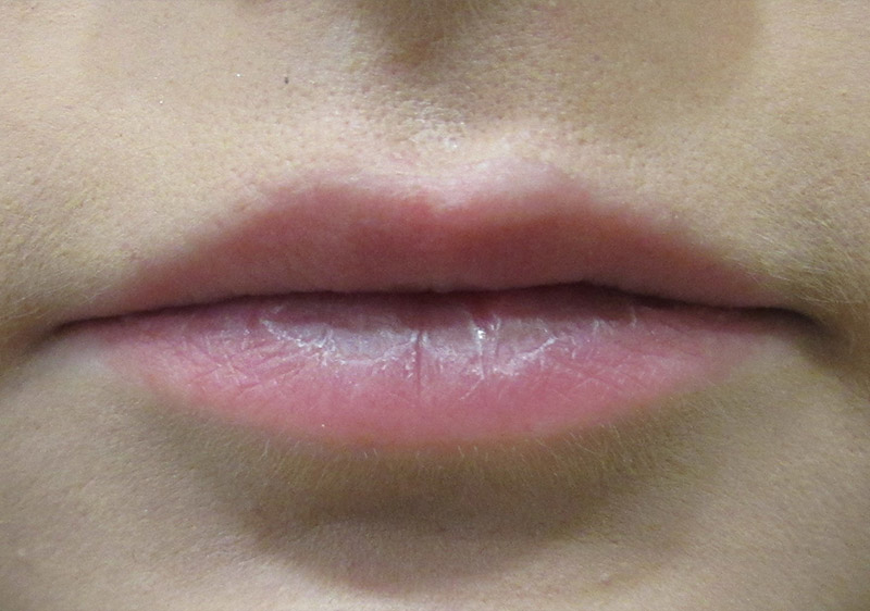 Injectables Before and After | SGK Plastic Surgery