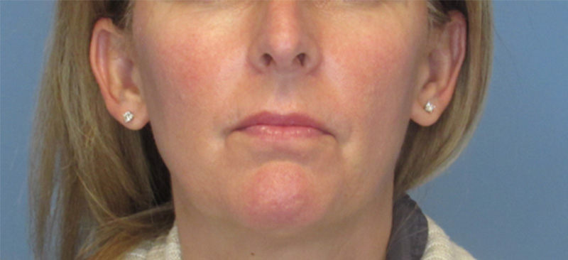 IPL Before and After | SGK Plastic Surgery