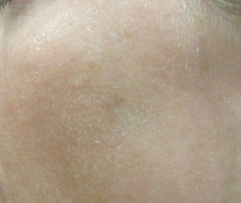 IPL Before and After | SGK Plastic Surgery